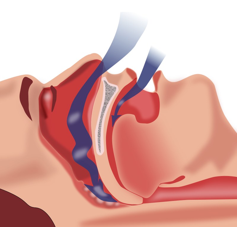 Schéma de l'obstruction des voies aériennes pendant le sommeil : l'air ne passe plus au niveau du pharynx